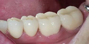 استفاده از لمینت زیرکونیا برای دندان‌های آسیاب