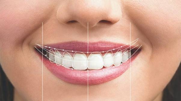 لمینت سرامیکی فلدسپات تاثیر بسزایی در زیبایی و سفید شدن دندان‌ها دارد.