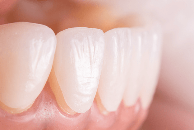 بهترین جنس لمینت دندان کدام است؟
