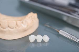 بریج و پل دندان چیست؟