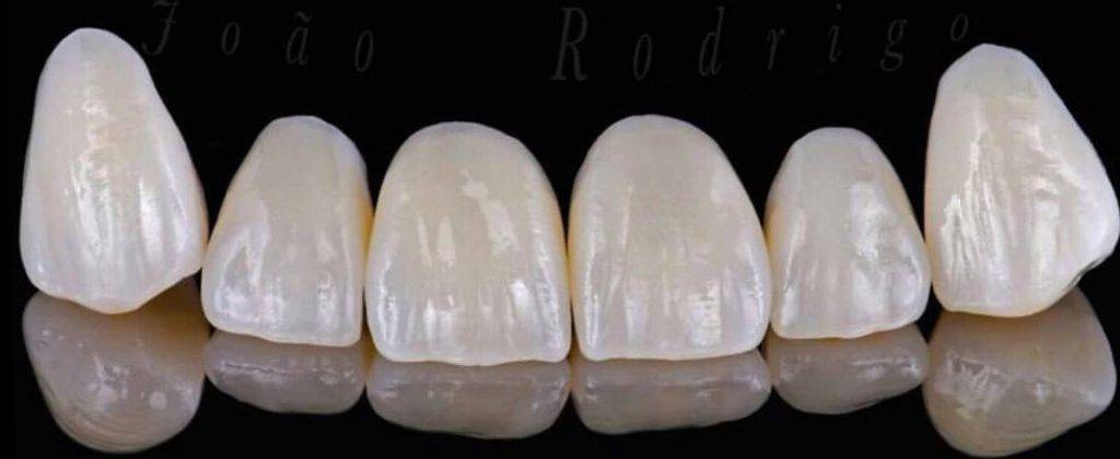 تراشکاری دندان در لمینت دندان نامرتب چگونه است؟