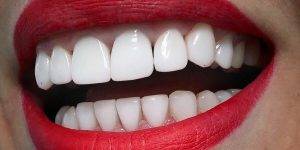 قیمت بلیچینگ یا سفید کردن دندان ها چقدر است؟