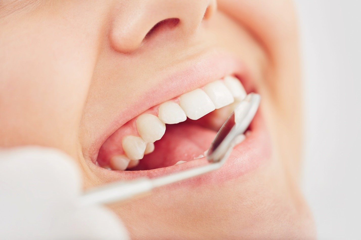 لمینت دندان های نامرتب چه مزایایی دارد؟