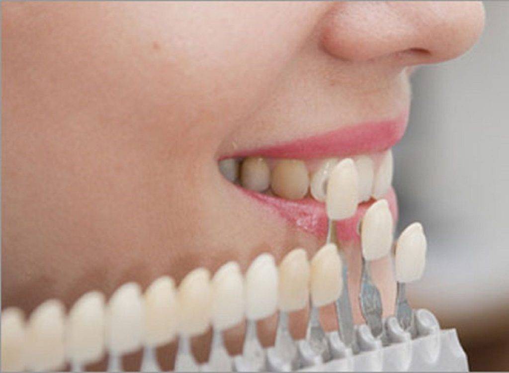 ویژگیهای خمیر دندان مخصوص لمینت دندان