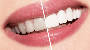 لمینت دندان بدون تراش امکانپذیر است؟ بررسی نحوه انجام و هزینه آن