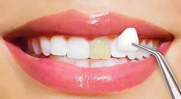 انجام لمینت دندان با قیمت مناسب و مشاوره رایگان