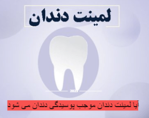 آیا لمینت دندان موجب پوسیدگی دندان می شود
