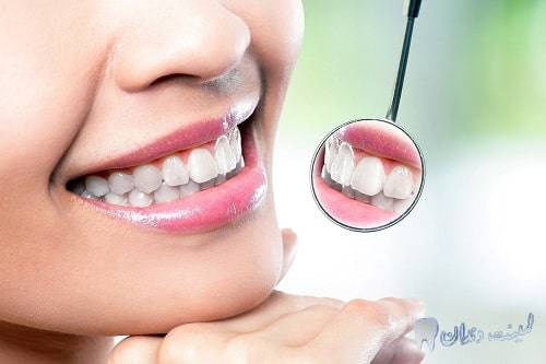 خطرات و عوارض لمینت دندان برای افراد سیگاری