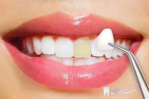 مناسب ترین لمینت دندان برای افراد سیگاری