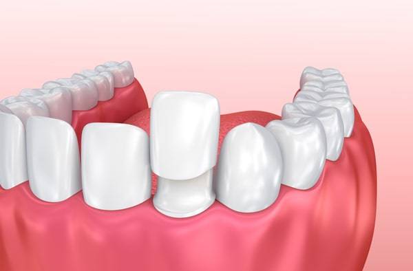 انواع لمینت دندان بر اساس اجزای سازنده آن که در انتخاب شما تاثیر دارند!