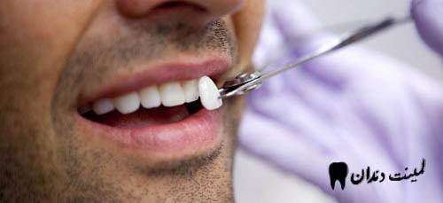 اقدامات متنوع و کاربردی بعد از لمینت دندان