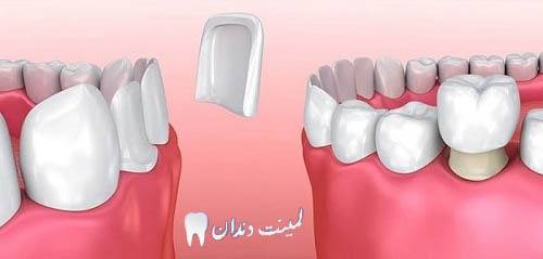 راه های سفید کردن دوباره لمینت دندان