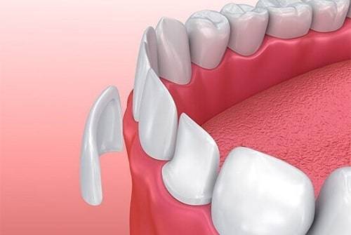 دلایل افتادن لمینت دندان چیست