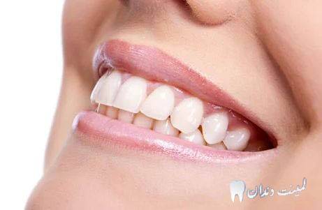 لمینت کریستالی دندان چیست؟