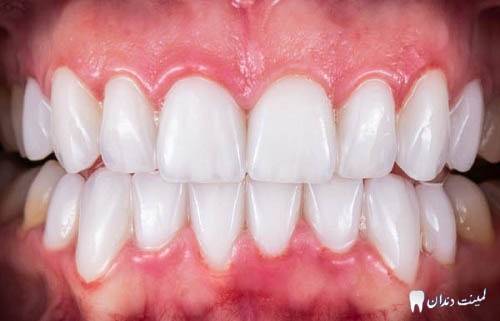به چه دلیل مراقبت از لمینت دندان مهم است؟